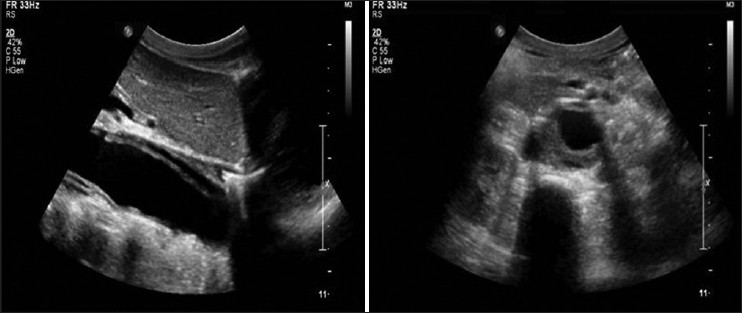 Doppler study - Longitudinal section view showing dissection flap within aorta separating true lumen and false lumen and peripheral thrombus in true lumen