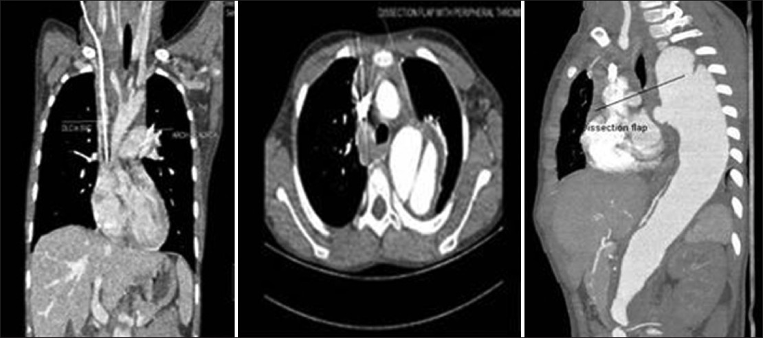 Computed tomography angio of coronal and axial view-showing normal ascending aorta, dissection starting after left subclavian artery extending up to bifurcation of the aorta with dissection flap and peripheral thrombus in true lumen