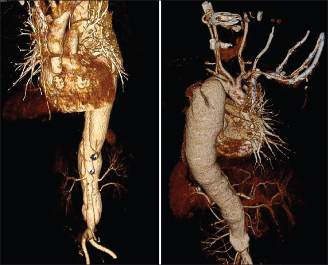 3D representation of aorta showing dissection starting after left subclavian artery extending to bifurcation of the aorta with the site of intimal flap and renal arteries of normal caliber on both sides (left side two renal arteries, right side one renal artery)