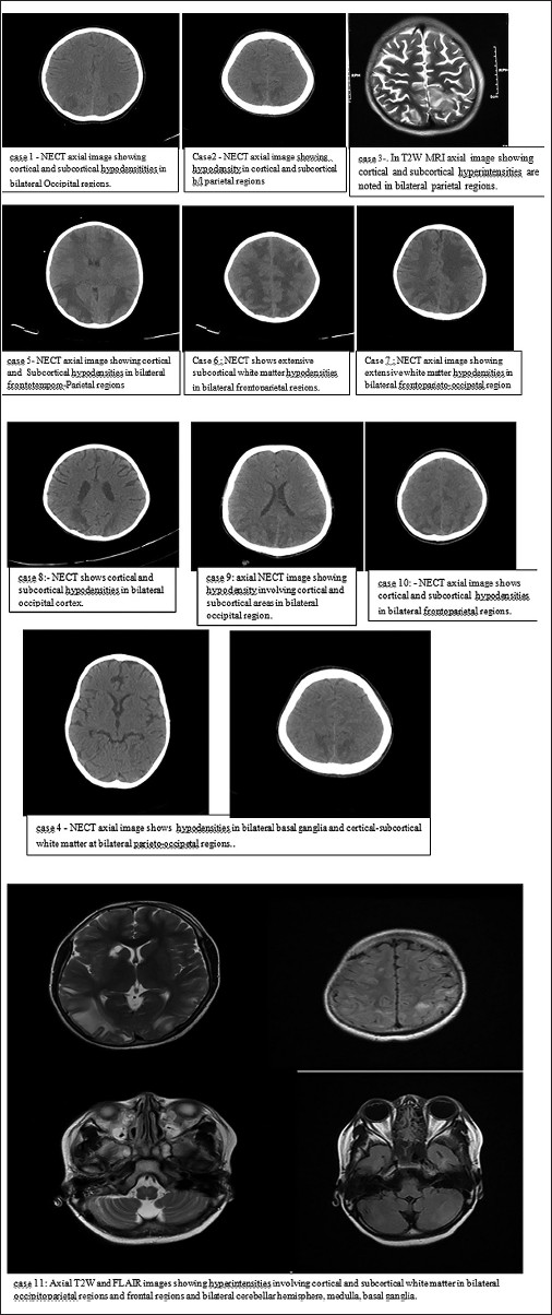 Computed tomography/Magnetic resonance imaging images of brain showing positive findings