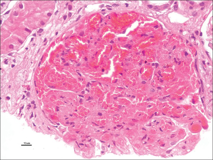 Glomerulus revealing blood filled and engorged capillaries with mesangiolysis (H and E, ×40)