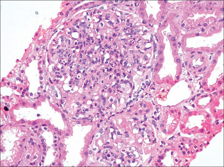 Global endocapillary proliferation (H and E, ×40)