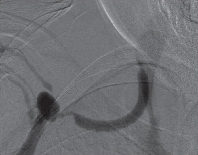 Fistulagram showing stenosis at both ends of the interpositioned veno-venous graft