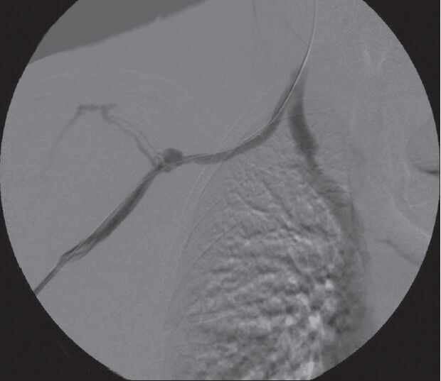 Postpercutaneous angioplasty fistulagram with satisfactory relief of the stenoses at both ends of the graft