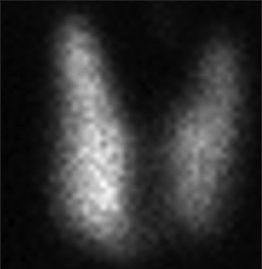 Technetium pertechnetate thyroid thyroid scintigraphy