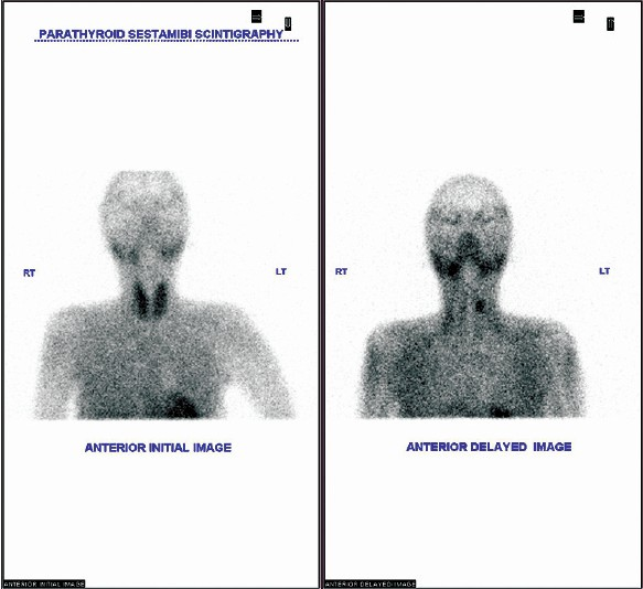 Technetium MIBI double phase parathyroid scintigraph