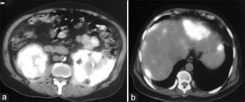 Positron emission tomography - computed tomography imaging. (a) Increased flurodeoxy glucose (FDG) uptake (standardized uptake value [SUV] max 9.5) is noted in the right kidney with regular margins. Increased FDG uptake is also noted in left kidney (SUV max 18.5) with irregular margins. Note is made of 9 mm calculus in left kidney lower calyx with mild hydronephrosis. (b) Avid FDG uptake is noted in multiple lesions in liver with largest lesion (7.9 cm × 5.9 cm, SUV max 13.8) in left lobe