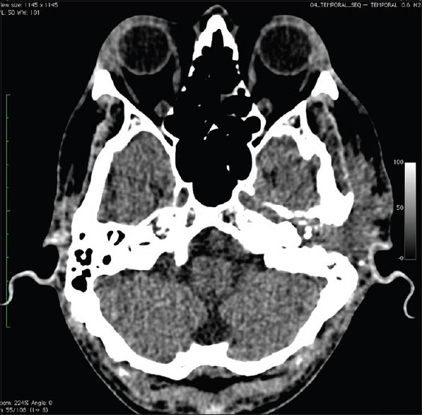 Computed tomography scan skull showing extensive damage of left middle ear and ossicles
