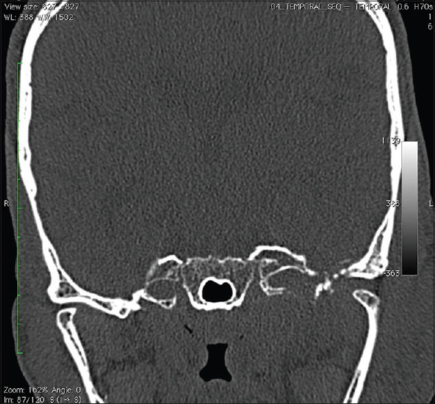 Computed tomography skull coronal bone window showing skull base erosion