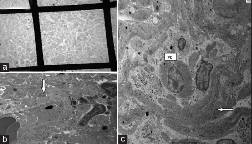 (a) Extensive interstitial fibrous deposition encircling nests of lymphoplasmacytic cells, demonstrating bird's eye pattern of fibrosis (transmission electron microscopy, ×610). (b) Bird's eye fibrosis in immunoglobulin - G4 tubulointerstitial nephritis - fibrous bundles (white arrow) encircling nests of swollen inflammatory cells (transmission electron microscopy, ×2550) (plasma cell). (c) Scattered electron-dense deposits (white arrow) in thickened tubular basement membrane remnants (transmission electron microscopy, ×6000)