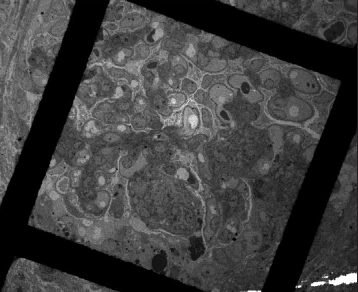 Segmental collapse with overlying podocyte hyperplasia (transmission electron microscopy, ×390)