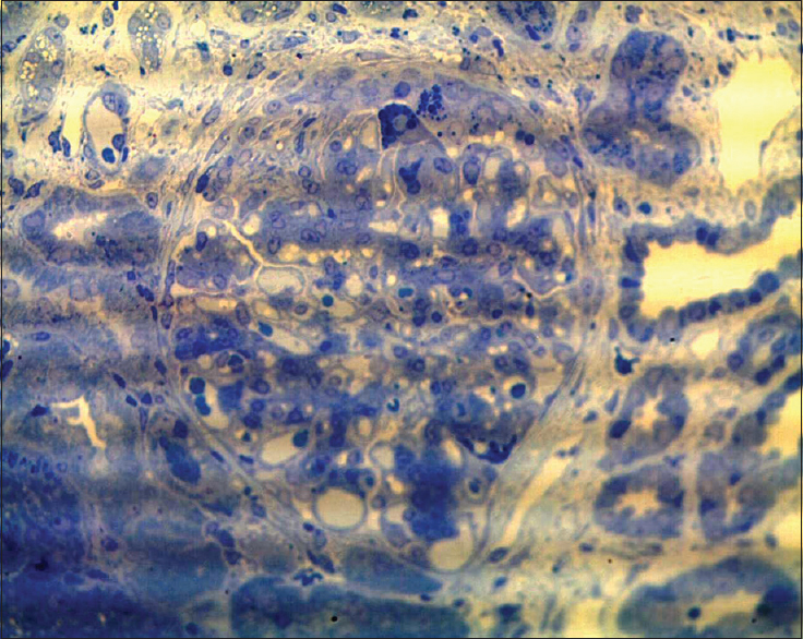 Toluidine blue stain highlights protein resorption droplets in hypertrophied podocytes in a glomerulus with segmental collapse and early pseudocrescent (semi-thin sections, toluidine blue, ×400)