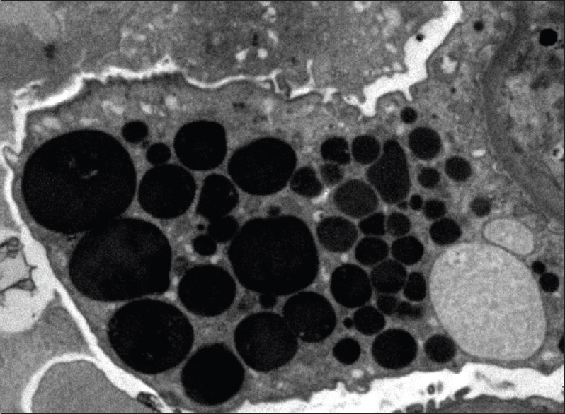 Enlarged podocyte containing protein resorption droplets (transmission electron microscopy, ×6000)