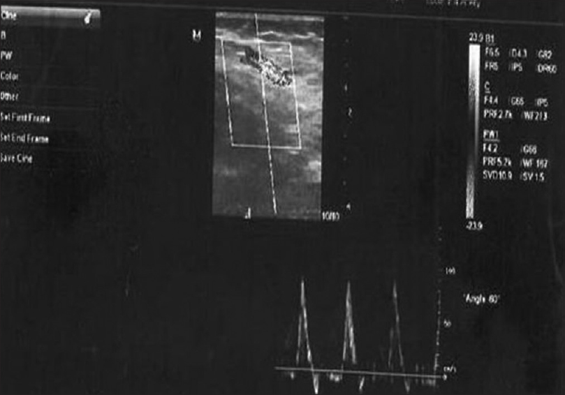 Doppler ultrasonography (in a gray scale) shows the brachial artery and its diameter in a patient with insulin-dependent diabetes mellitus and peak velocity
