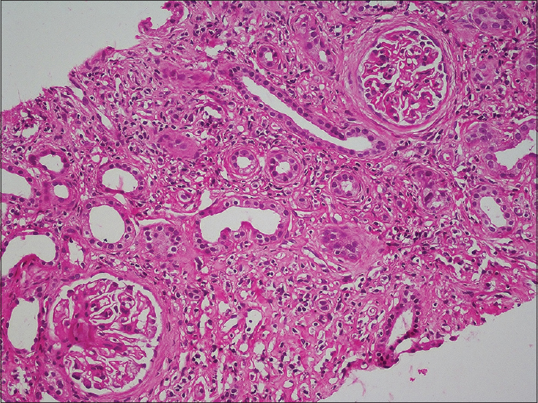 Chronic inflammatory cell infiltrate containing numerous plasma cells in a fibrotic interstitium (H&E stain)