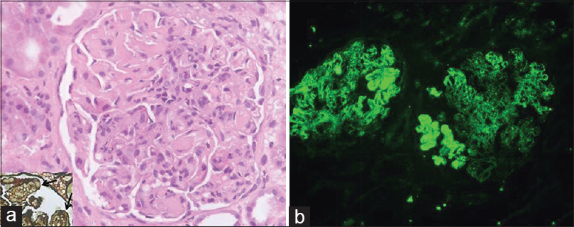 Renal histology showing enlarged glomerulus with endocapillary proliferation, basement membrane thickening, hyaline thrombi (a) and widespread splitting of basement membrane on silver stain (arrows; inset); immunofluorescence showed strong (4+) capillary wall and mesangial immune deposits of immunoglobulin A (b) (H and E, ×400; FITC, ×200)