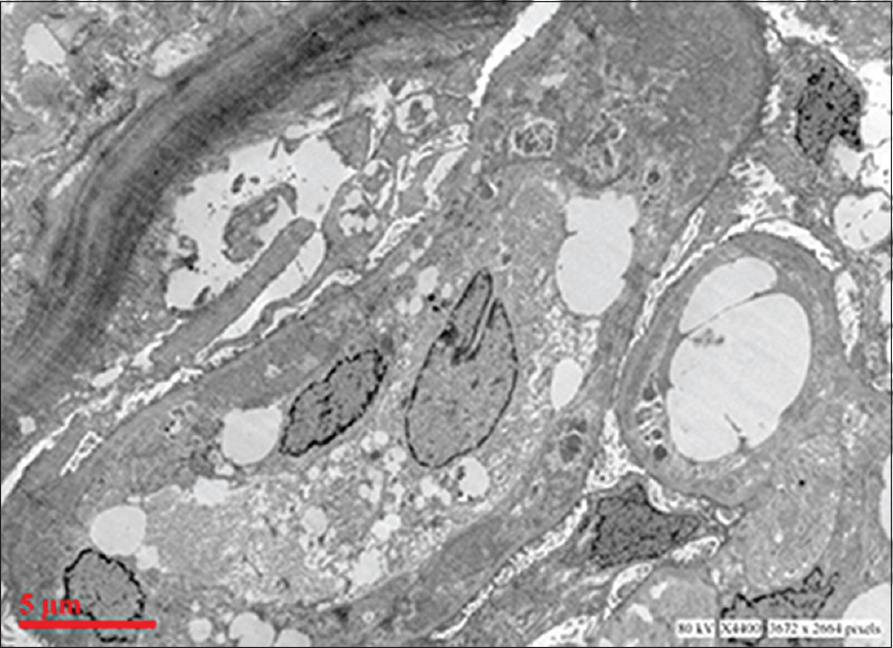 Electron micrograph showing extensive glomerular subendothelial electron dense deposits, duplication of basement membrane and mesangial interposition (uranyl acetate and lead citrate)