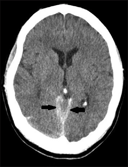 Repeat noncontrast computerized tomography brain after 4 days, showing significant resolution of subarachnoid hemorrhage