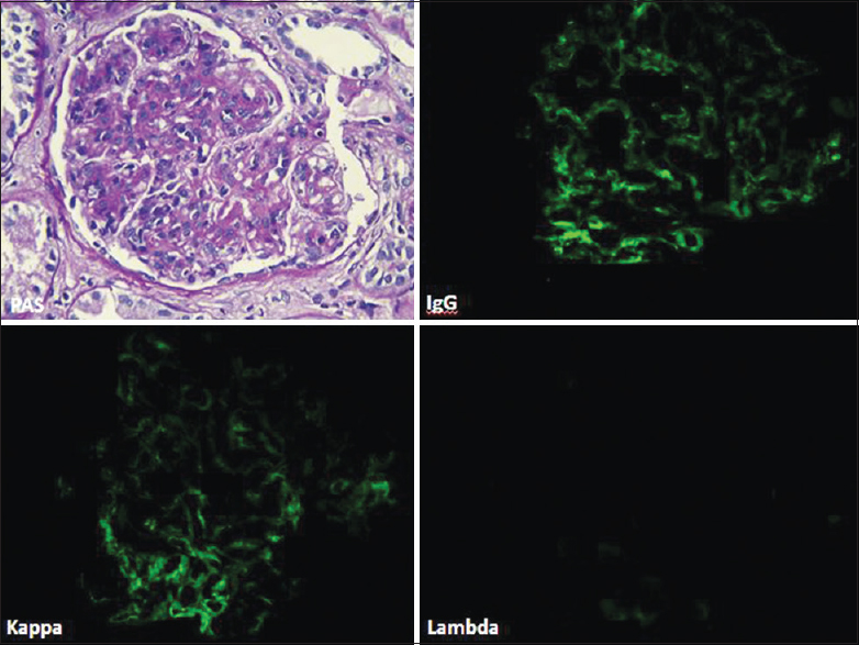 Photomicrograph (case 3) showing MPGN pattern with segmental endocapillary proliferation (PAS, ×40). The glomerulus showed deposits of IgG and kappa only along glomerular capillary loops and in mesangium (direct immunofluorescence, fluorescein, IgG, kappa, lambda, ×40)