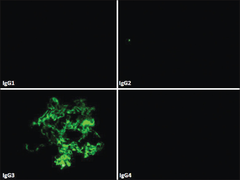 Direct immunofluorescence (case 3) showing IgG subtyping with IgG3 deposits only with absence of other three subclasses of IgG (fluorescein, IgG1, IgG2, IgG 3, IgG4, ×40)