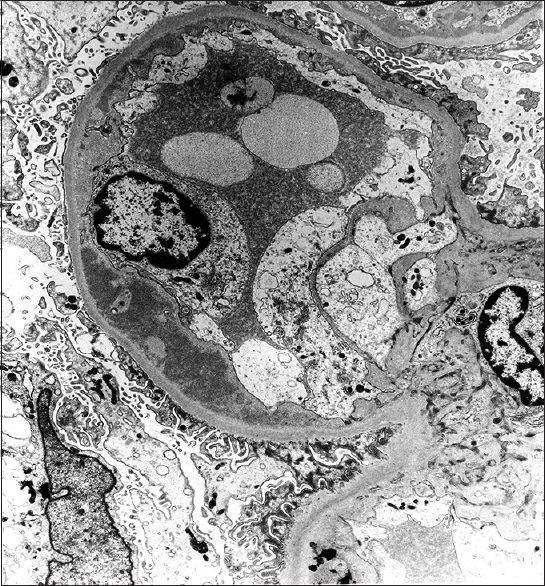 Electron microscopy (case 3) showed subendothelial electron dense deposits with effacement of foot processes of podocytes (Uranyl acetate, ×17,100)