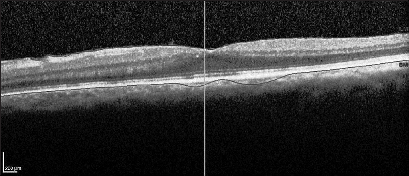 Optical coherence tomography image shows no evidence of active inflammation in the left eye after the withdrawal of nonsteroidal anti-inflammatory drug