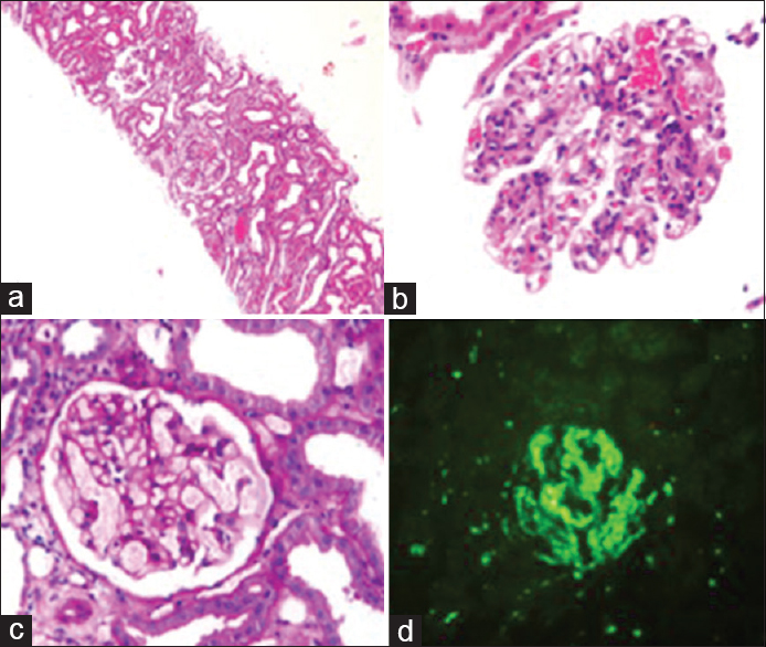 Photomicrograph of renal biopsy. (a) light microscopy, (b and c) glomerulus showing mesangial proliferation and neutrophilic infiltrates, (d) immunofluorescence showing abundant peripheral and mesangial C3 deposits
