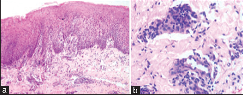Photomicrograph of the mucosal ulcer. (a) light microscopy showing subepithelial vascular proliferation, (b) perivascular lymphocytic infiltration with scattered neutrophilic infiltrates