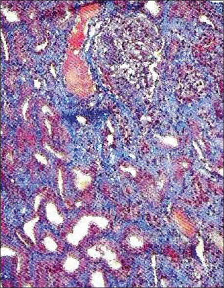 Features of mesangial proliferative glomerulonephritis