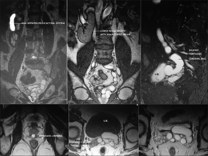 On magnetic resonance imaging (coronal, sagittal, and axial views) studies, the blind ending ureteric duct showed hyperintense signal on T1 and T2 sequences but a relatively low signal intensity to that of the pelvicalyceal system of the crossed fused kidneys and was not suppressed on stir sequence. The lower end of left ureteric duct is opening into the prostatic urethra