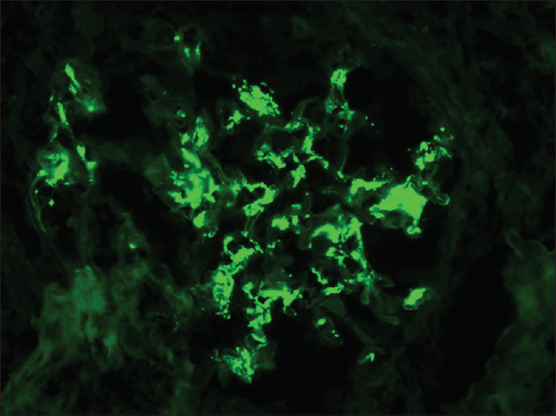 Immunofluorescence showing intense staining of immunoglobulin A deposits