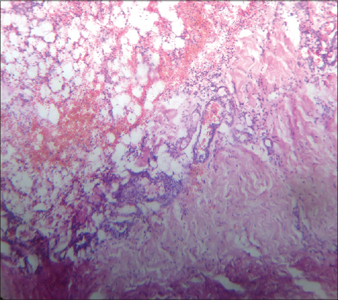 Histopathologic examination of peritoneal and omental biopsies revealed adipose tissue cells with large areas of fibrosis, collagenization, inflammatory cells, hemorrhage, and hemosiderin laden macrophages consistent with sclerosing peritonitis