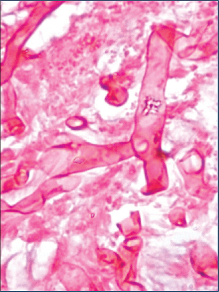 Thick-walled, aseptate, obtuse-angled branching hyphae on high power view with PAS stain