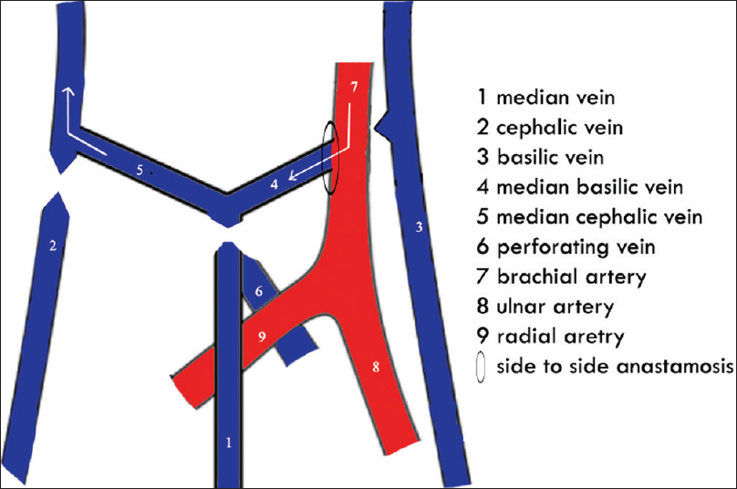 Brachiocephalic arteriovenous fistula through median antecubital vein at the elbow