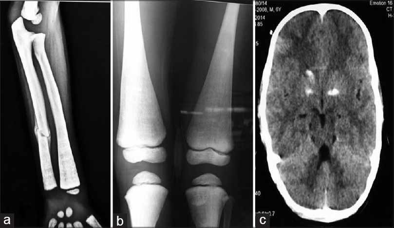 (a) X-ray left forearm showing increased density, with a classic chalk stick fracture of left ulna. (b) x-ray knees also suggestive of diffuse increase in bone density. (c) Noncontrast computed tomography head showing bilateral basal ganglia calcification