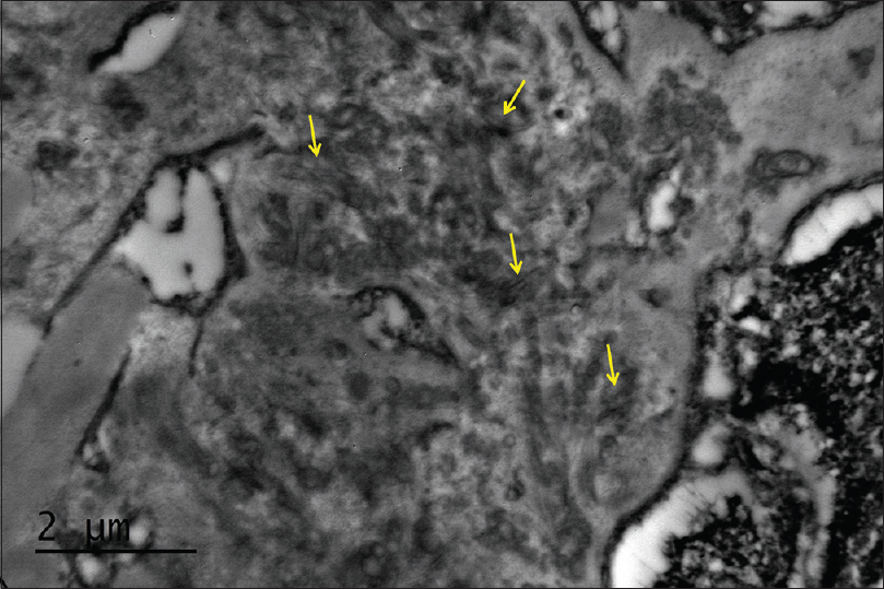 Electron microscopy shows curvilinear bands of collagen in the mesangium