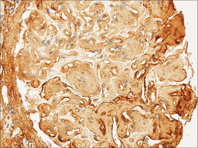 Immunohistochemical stain for Type III collagen is positive over the glomeruli capillary loops and mesangium
