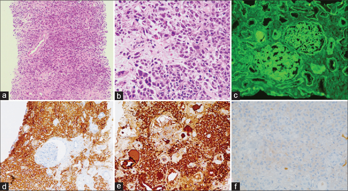 Case 1: (a) Dense infiltrate of plasma cells in the interstitium, compressing the tubules and microvasculature (×4, H and E). (b) Atypical plasma cells can be appreciated with atypical hyperchromatic nuclei and many binucleated forms (×4, H and E). (c) Immunofluorescence study showing linear deposits of kappa along the glomerular basement membrane, Bowman's capsule and tubular basement membrane. (d) Immunostain for CD138 highlighting the plasma cells. (e) Immunostain for kappa is positive in the neoplastic plasma cells while that for lambda is negative (f)