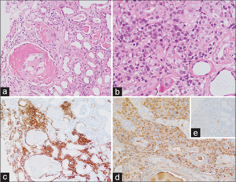 Case 2: (a) Bright eosinophilic casts in the dilated lumen of tubules inciting histiocytic reaction, and tubules showing features of tubular injury (×20, H and E). (b) Aggregates of atypical plasma cells and tubules showing marked thickening of the tubular basement membrane (×40, H and E). (c) CD138 immunostain highlighting the interstitial plasma cells. (d) Immunostain for lambda revealing lambda restricted plasma cells, and negative kappa (e, inset)