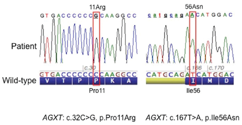 Sequences and electropherograms showing the two missense mutations identified in the affected child; on the left sequence around codon 11 and the right sequence around codon 56. The wild-type nucleotide and protein sequence (amino acid in one letter code) are reported below