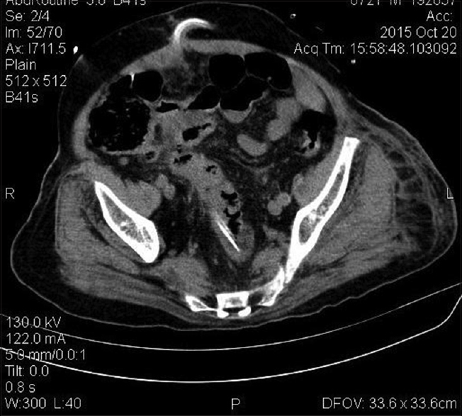 Chronic ambulatory peritoneal dialysis catheter tip seen inside the rectal lumen