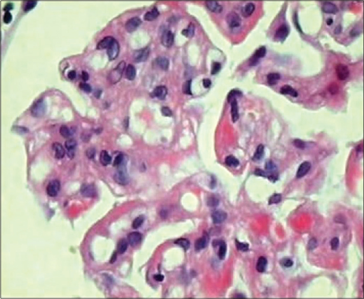 Glomerulus showing increased cellularity, eosinophilic deposits, and thickened basement membrane (H and E, ×450)