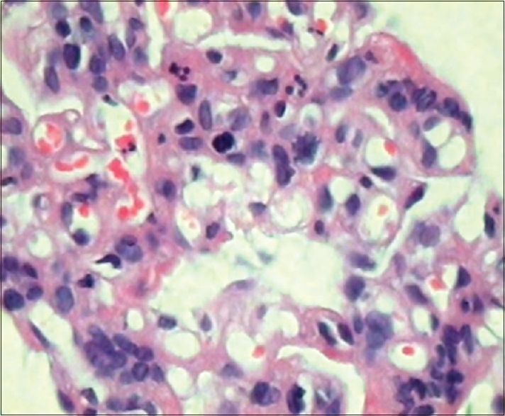 Marked increase in mesangial cells and a few polymorphonuclear leukocytes (H and E, ×450)