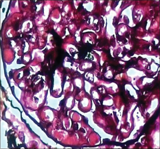 Cryoglobulin pseudothrombi and double contouring of basement membrane (Jones silver, ×450)