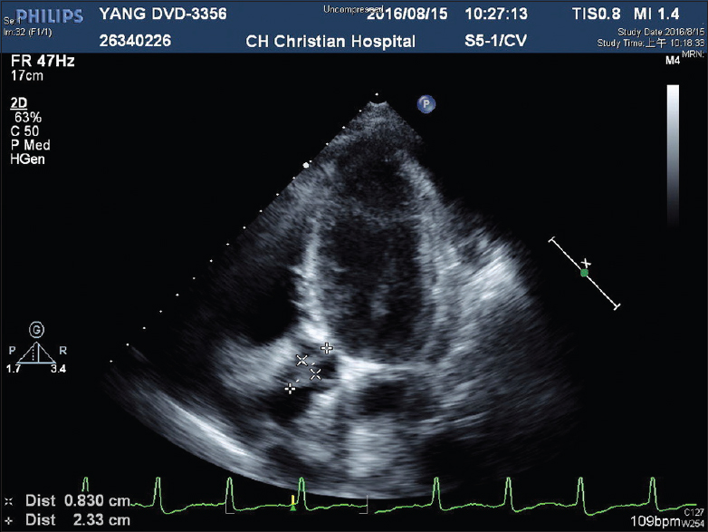 Vegetation (2.33 cm × 0.83 cm) over aortic valve revealed by echocardiography (cross mark)