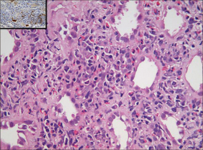 Photomicrograph of kidney biopsy shows inflammation composed of lymphoplasmacytic cells along with eosinophils in insinuating pattern. Plasma cells were positive for IgG4 immunostain (inset) (H and E, IHC IgG4 inset: ×40)