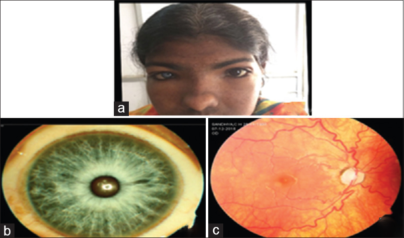 (a) White forelock, abnormal facies; (b) heterochromia iridis; (c) tessellated hypopigmented fundus
