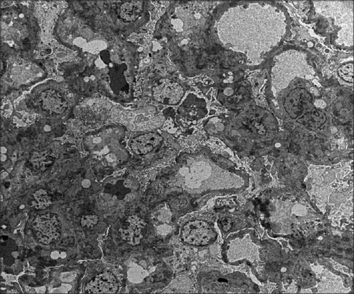 Electron microscopy image showing diffuse effacement of visceral epithelial cell foot processes. No electron dense or organized deposits are seen in mesangial areas of glomerular basement membrane. The ultrastructural features indicate a primary podocytopathy