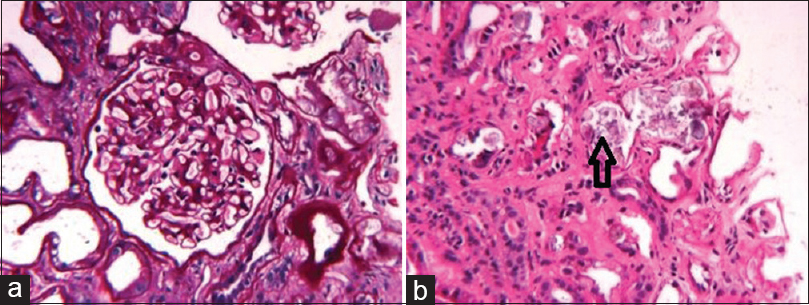 (a) Periodic acid–Schiff stain reveals mild mesangial expansion without hypercellularity and normal glomerular basement morphology (b) Calcium oxalate crystals in lumen of renal tubule (arrow) on H and E stain