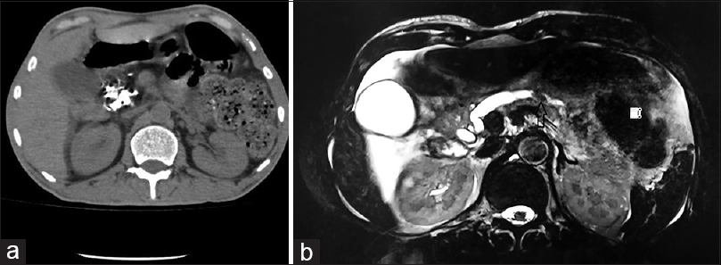 (a) Computed tomography abdomen shows diffuse calcification of head of pancreas (b) Magnetic resonance cholangiopancreaticogram revealed diffuse pancreatic atrophy with filling defect in the dilated main pancreatic duct suggesting calcification